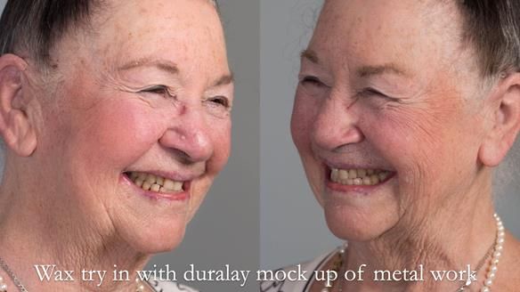 Finlay's Case Study Newsletter 40 - Immediate Mk 1 RPD to Definitive Mk 2 RPD - full protocol