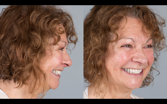 Figure 87 Definitive dentures fitted.