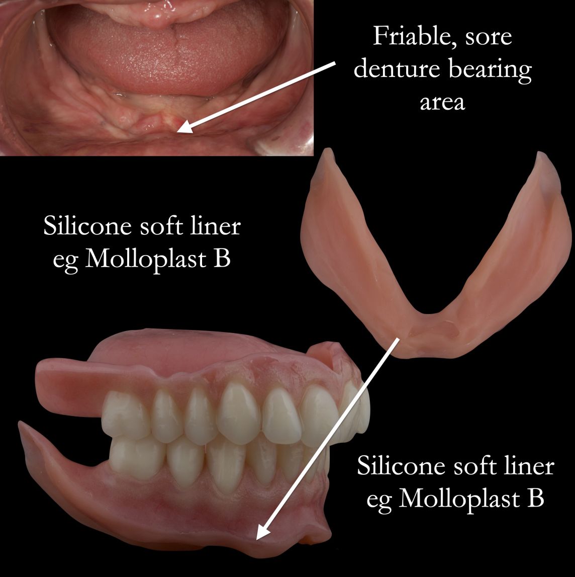 Soreness of the lower during denture construction procedures 