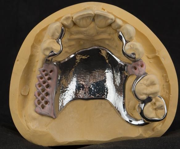 Figure 71 cobalt chromium framework - Scandinavian design - keeping the denture components 3mm away from the gingival margin.