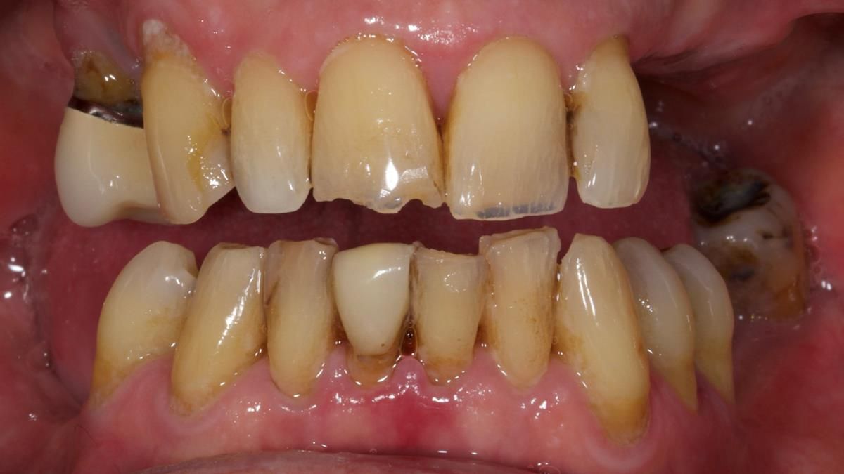 Newsletter 89 – Simon: A Challenging Kennedy Class II Division 1 Upper CoCr Partial Denture with a High Smile Line