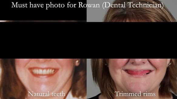 Finlay's Newsletter 58 Gasket upper partial denture for Zoe