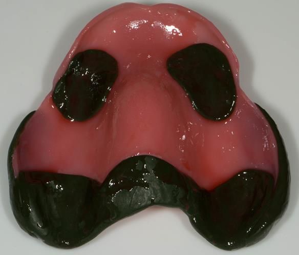 Figure 77 Maxillary special tray prepared with alginate adhesive