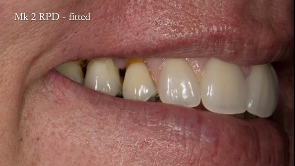 Finlay's Newsletter 63 Case study provision of metal based Scandinavian RPD - functional 10 years on