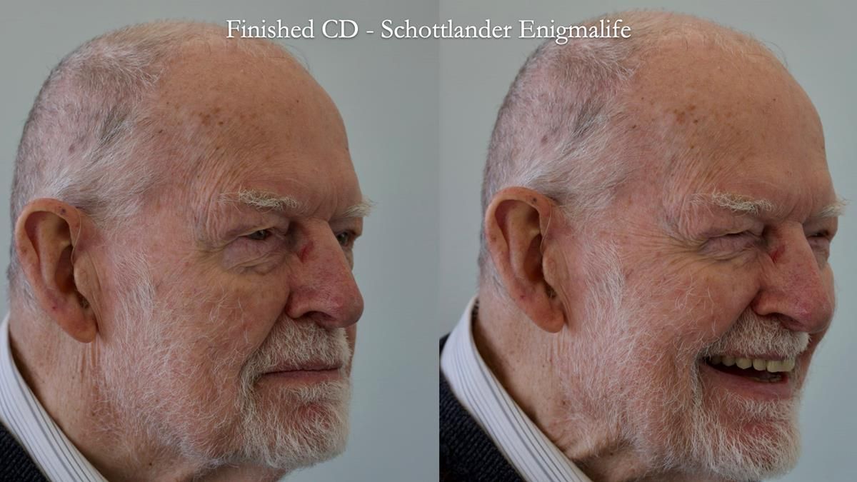 Newsletter 87 – Father Peter: A Partial Denture that needed Minor Miracle