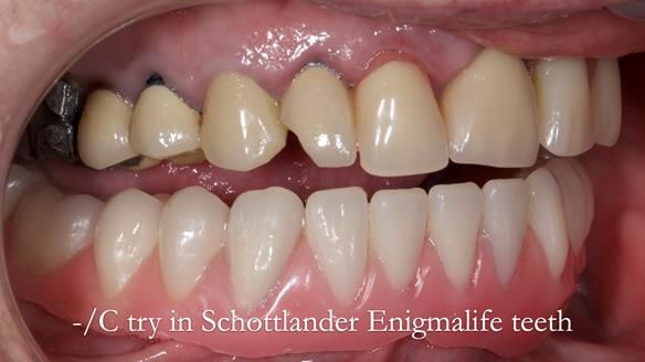 Newsletter 44 - extreme removable prosthodontics – engineering a super-strong and ultra-thin over denture
