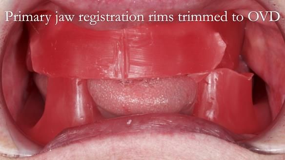 Replacing Madeline’s Complete denture FULL PROTOCOL