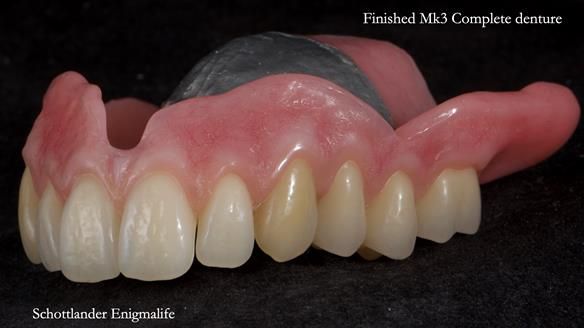 Newsletter 77: Jeremy’s case – immediate complete upper denture