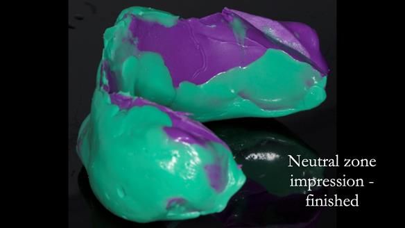 Newsletter 83: Sheila’s Complete Denture Success
