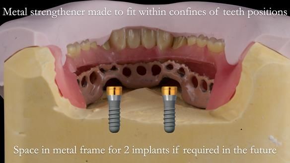 Newsletter 50 Special edition Complete Dentures FULL PROTOCOL