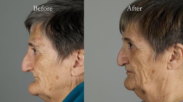 Newsletter 83: Sheila’s Complete Denture Success