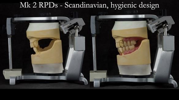 Finlay's Case Study Newsletter 40 - Immediate Mk 1 RPD to Definitive Mk 2 RPD - full protocol