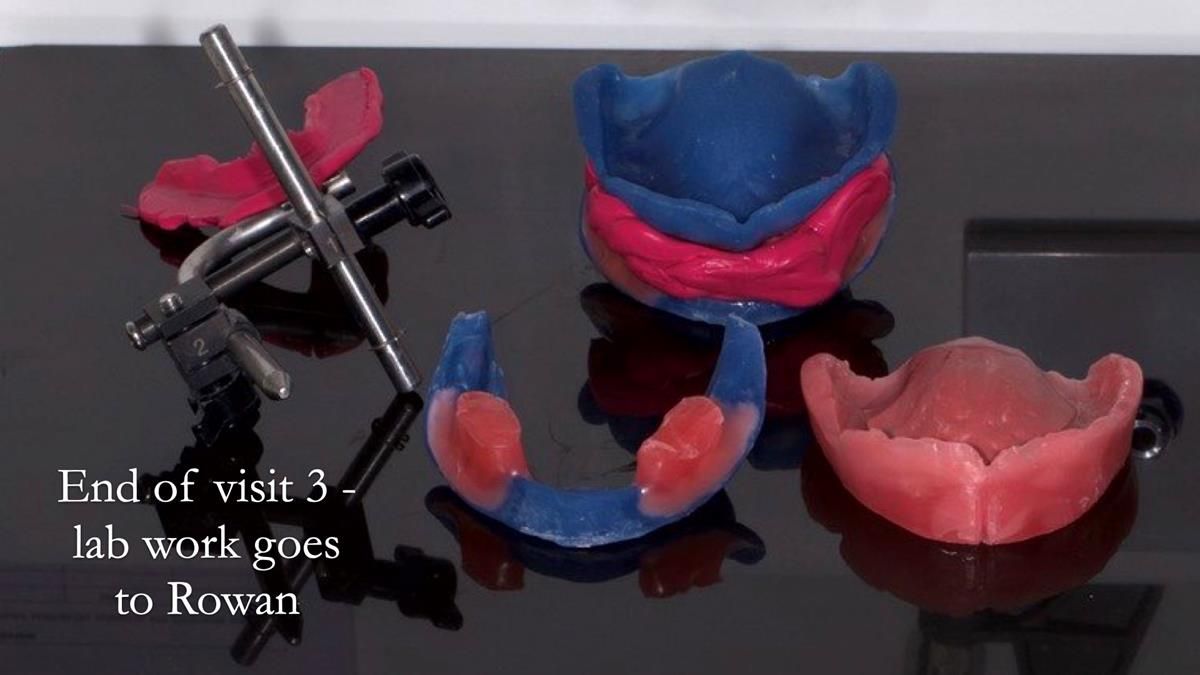 Fin’s Newsletter 88 — Complete dentures - full protocol… he rearranged his own teeth!