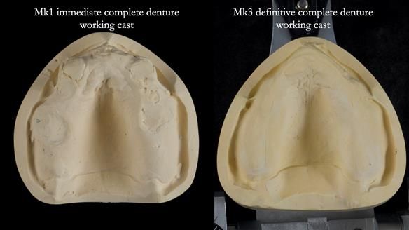 Newsletter 77: Jeremy’s case – immediate complete upper denture