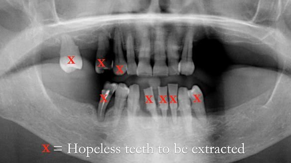 Finlay's Case Study Newsletter 40 - Immediate Mk 1 RPD to Definitive Mk 2 RPD - full protocol