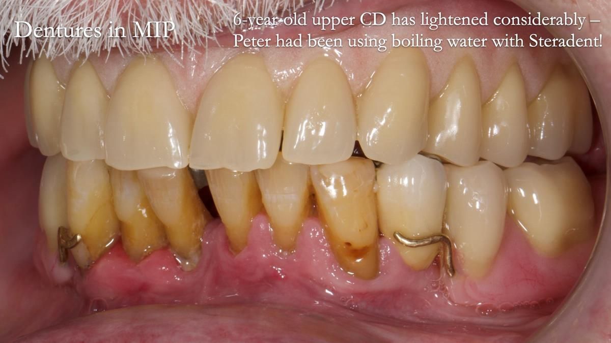 Newsletter 87 – Father Peter: A Partial Denture that needed Minor Miracle