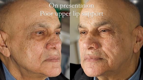 Managing poor implant positioning with complete dentures and Locator attachments - full protocol Newsletter 41