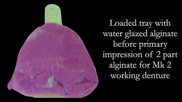 Finlay's Case Study Newsletter 40 - Immediate Mk 1 RPD to Definitive Mk 2 RPD - full protocol