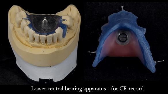 Newsletter 77: Jeremy’s case – immediate complete upper denture