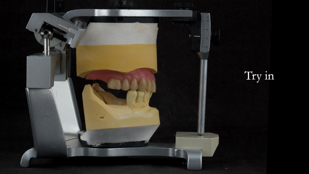 Newsletter 87 – Father Peter: A Partial Denture that needed Minor Miracle