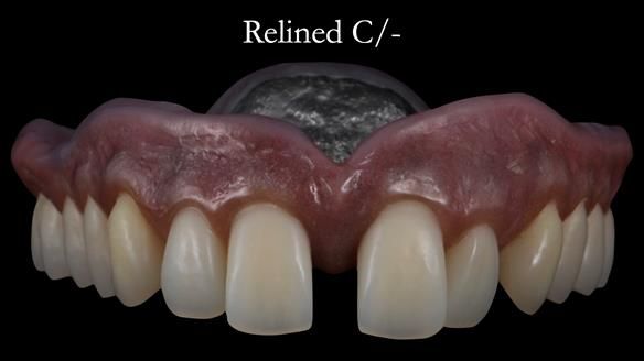 Newsletter 53 showing the making and fitting of ultra life-like dentures for Valena