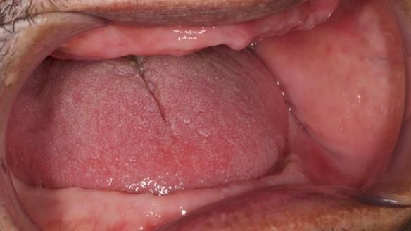 Finlay's Newsletter 62 provision of extractions and metal based complete dentures for Rafique