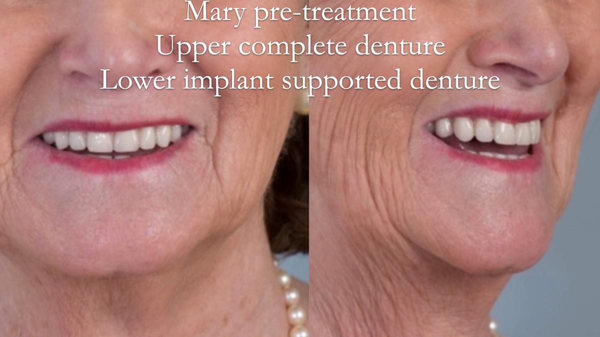 Pre-treatment - upper complete denture lower - implant supported complete denture Patient unhappy with denture appearance and fit of the lower denture