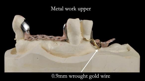 Finlay's Newsletter 59 Ultra hard partial dentures made for Gill