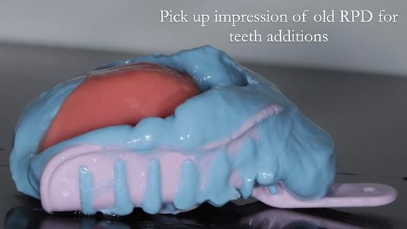 Finlay's Newsletter 62 provision of extractions and metal based complete dentures for Rafique