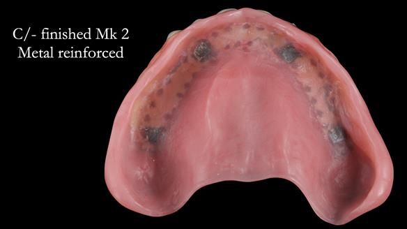 Newsletter 52 Managing Jo’s failing dentition with extractions and Mk 1/Mk 2 complete upper dentures and lower partial dentures FULL PROTOCOL