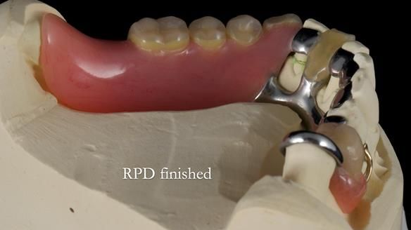 Newsletter 55 Provision of metal based partial dentures for Zephyrine with a repaired cleft lip and palate