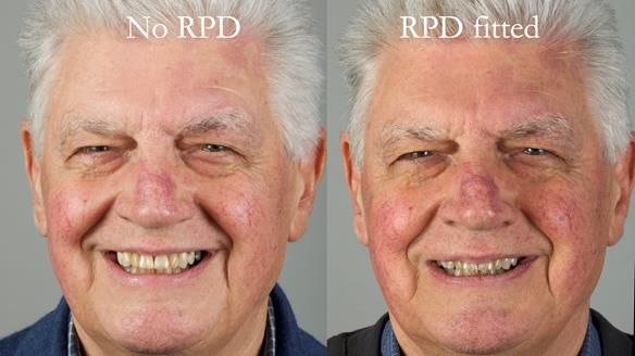 Finlay's Newsletter 64 case study - provision of a Kennedy class 2 metal based Scandinavian RPD for Ian