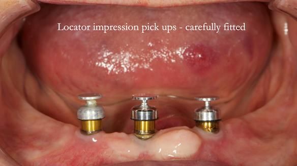 Locator impression pick ups - carefully fitted