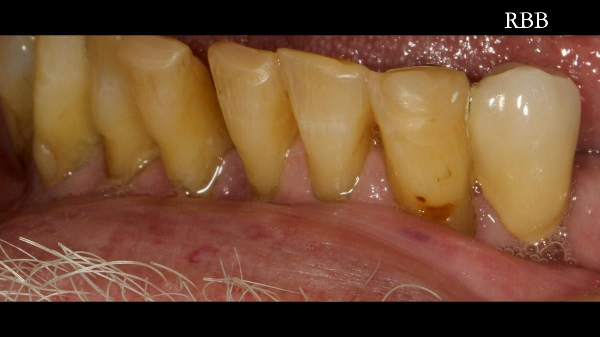 Newsletter 87 – Father Peter: A Partial Denture that needed Minor Miracle