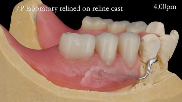 Newsletter 52 Managing Jo’s failing dentition with extractions and Mk 1/Mk 2 complete upper dentures and lower partial dentures FULL PROTOCOL