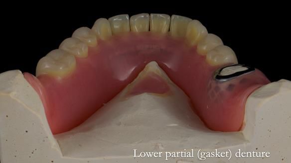Newsletter 82 Mary - A complete upper and a one-tooth gasket denture