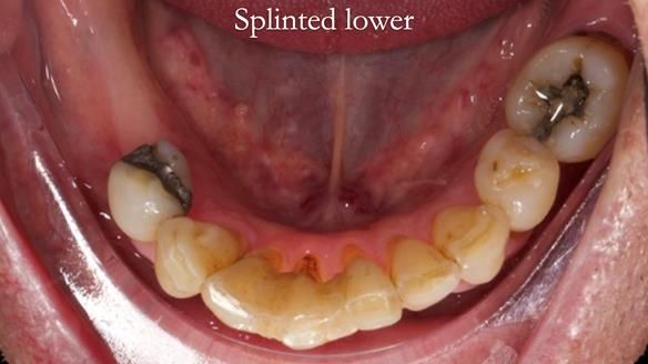 Newsletter 54 case presentation upper complete denture and lower Scandinavian designed hygienic partial denture for David