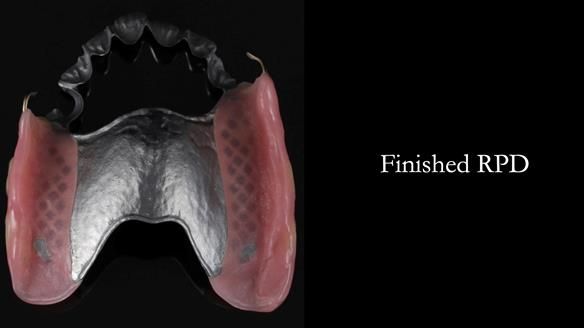 Newsletter 56 showing the making and fitting of a bilateral free end saddle upper removable partial denture (RPD) for patient with pemphigus