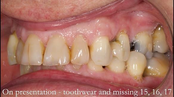 Finlay's Newsletter 64 case study - provision of a Kennedy class 2 metal based Scandinavian RPD for Ian