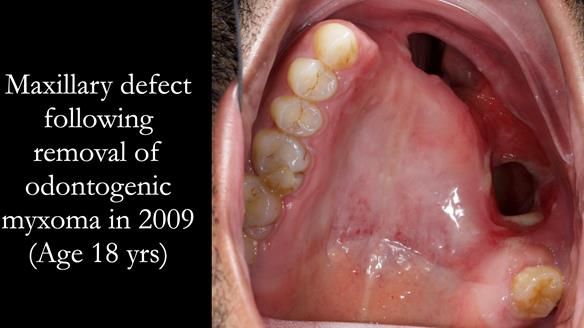 Upper metal base partial denture/occlusal stabilisation splint/obturator - full protocol