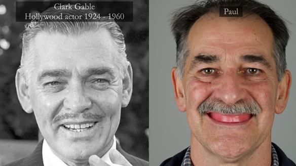 Newsletter 78: What do Clark Gable and a Locator® overdenture have in common?