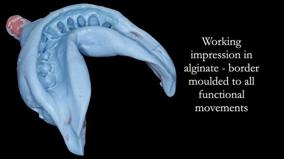 Newsletter 52 Managing Jo’s failing dentition with extractions and Mk 1/Mk 2 complete upper dentures and lower partial dentures FULL PROTOCOL