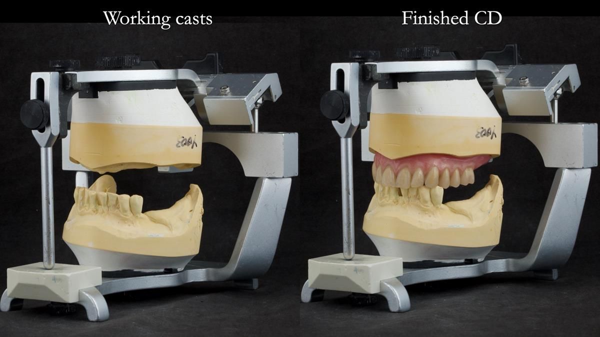 Newsletter 87 – Father Peter: A Partial Denture that needed Minor Miracle