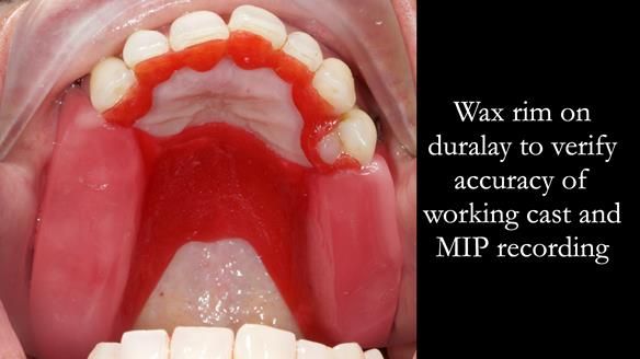 Newsletter 56 showing the making and fitting of a bilateral free end saddle upper removable partial denture (RPD) for patient with pemphigus