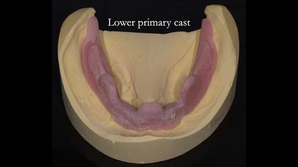 Newsletter 75: Marion’s case - Step-by-step complete denture workflow