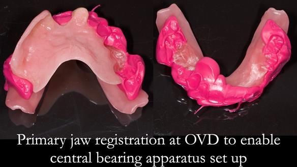 Newsletter 44 - extreme removable prosthodontics – engineering a super-strong and ultra-thin over denture