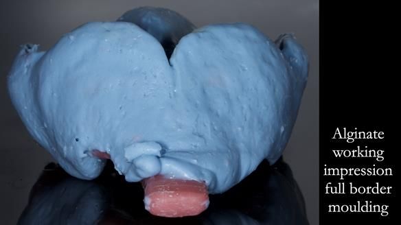 Newsletter 77: Jeremy’s case – immediate complete upper denture