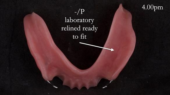 Newsletter 52 Managing Jo’s failing dentition with extractions and Mk 1/Mk 2 complete upper dentures and lower partial dentures FULL PROTOCOL