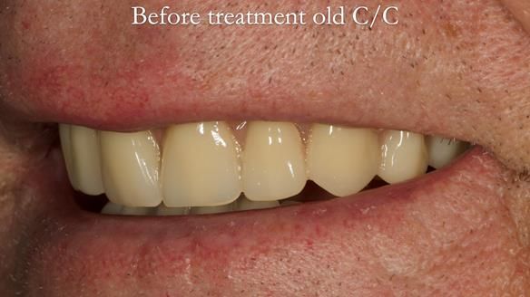 Complete denture Class II div 2 deep overbite Newsletter 39