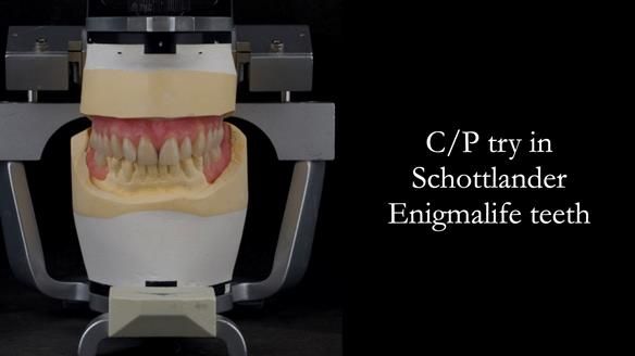 Solving Linda’s Failed “All on 4” implant bridges - full protocol Newsletter 42